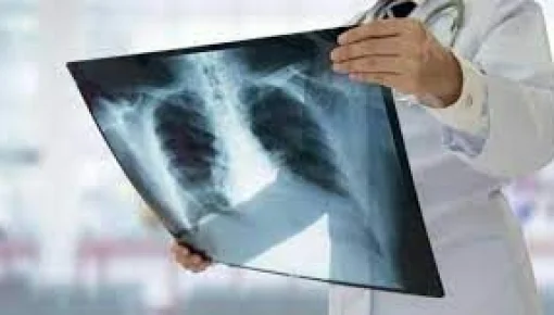 Más de 1,6 millones de personas murieron por tuberculosis en 2021